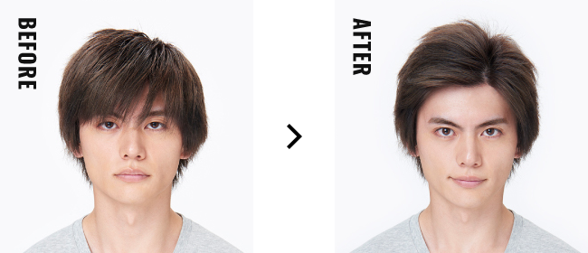 想要漂亮旁分! before after